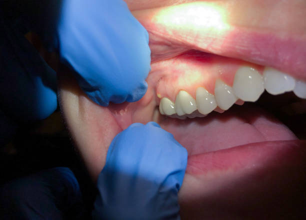 Best Emergency Tooth Extraction in Nashville, TN